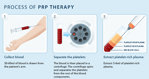 Nonsurgical Hair Loss Treatment Platelet Rich Plasma PRP Stem ACell 