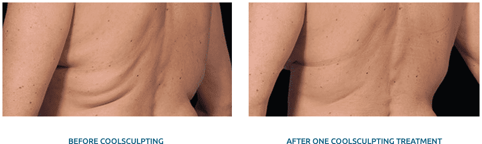 CoolSculpting Results | Before and After
