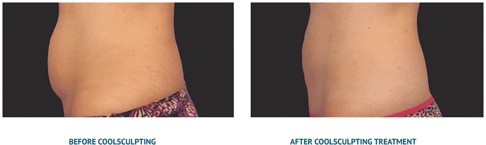 CoolSculpting Results | Before and After