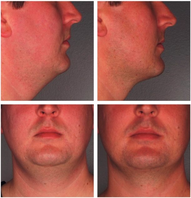 Kybella Before And After Photos