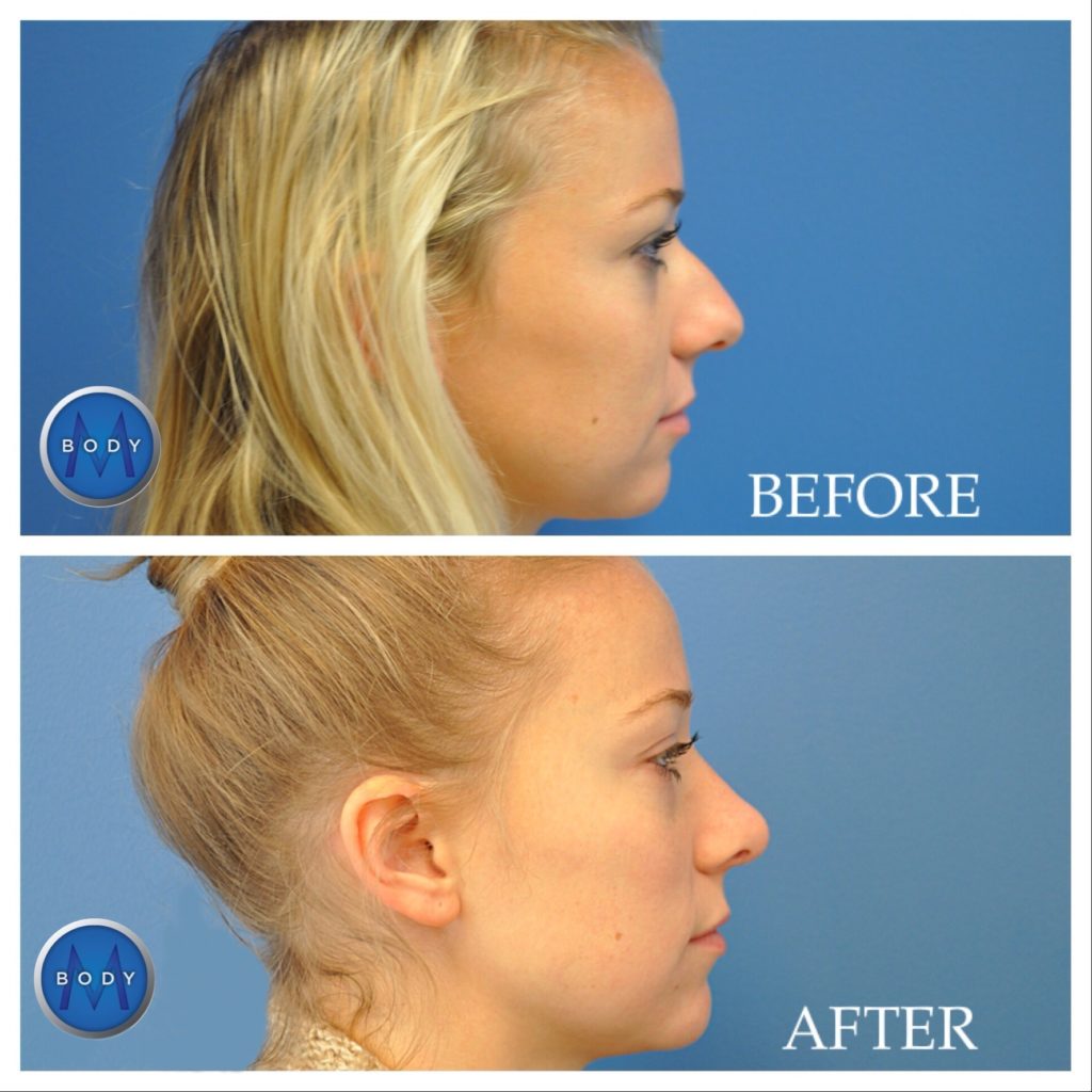 Rhinoplasty - Nose Surgery in Cleveland, OH